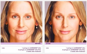 juvederm san francisco