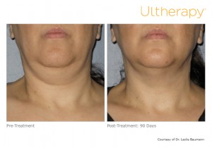 ultherapy-0014-0086w_before-90daysafter_neck