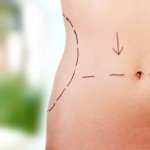 Liposuction for body contouring in San Francisco