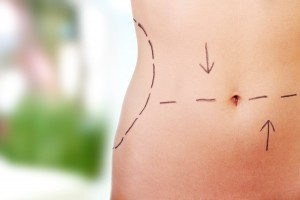 Liposuction for body contouring in San Francisco